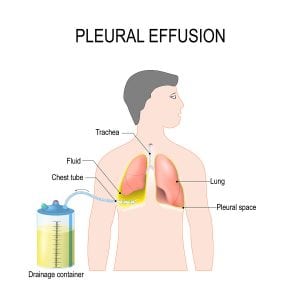 Pleuraergussflüssigkeit in der Lunge