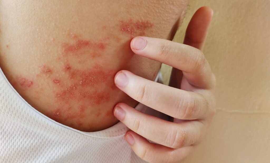 Eczema rash