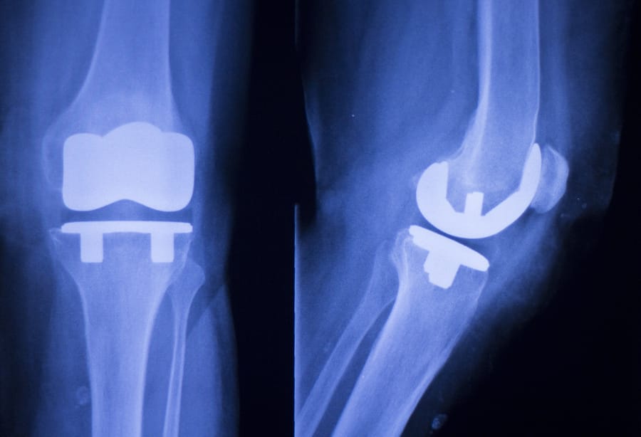 Attune Knee Implants & Complications