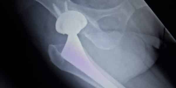 $2M Defective Hip Implant Verdict In NM