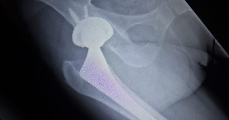 $2M Defective Hip Implant Verdict In NM